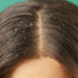 10 Home Countermeasures To Fight Dandruff